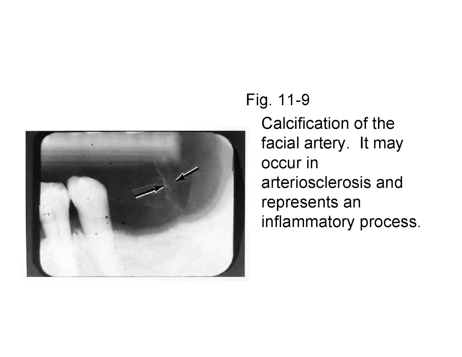 What is involved in calcification?